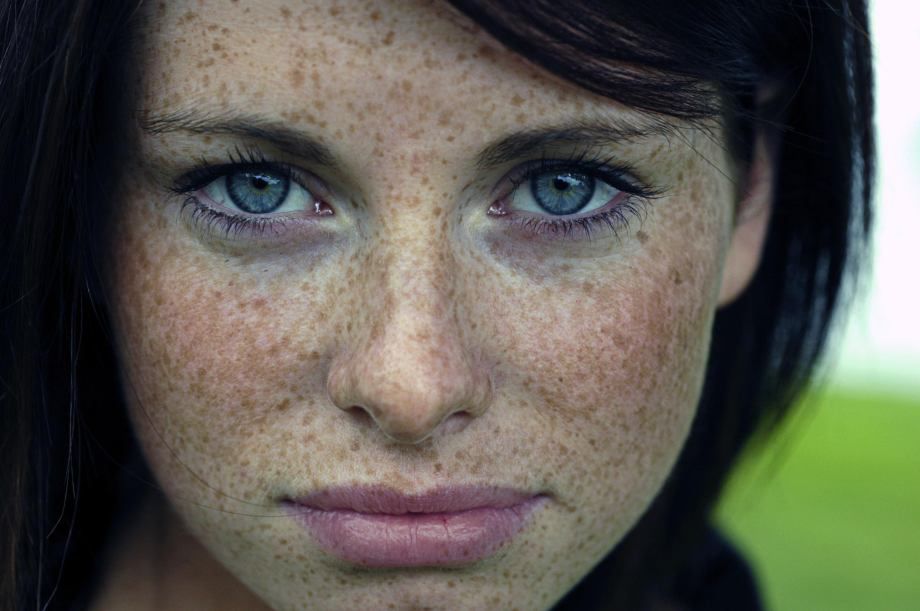 Freckles to the Front Please 