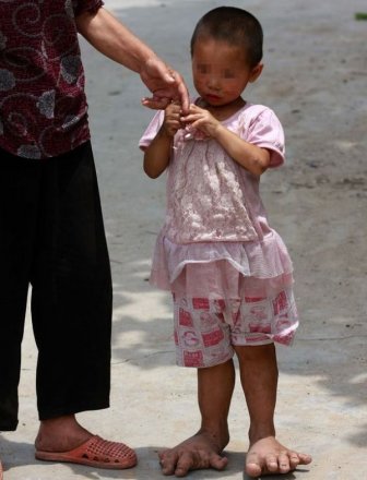 Chinese Girl with Giant Feet