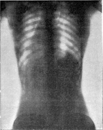 X-Rays Of Women Wearing Corsets