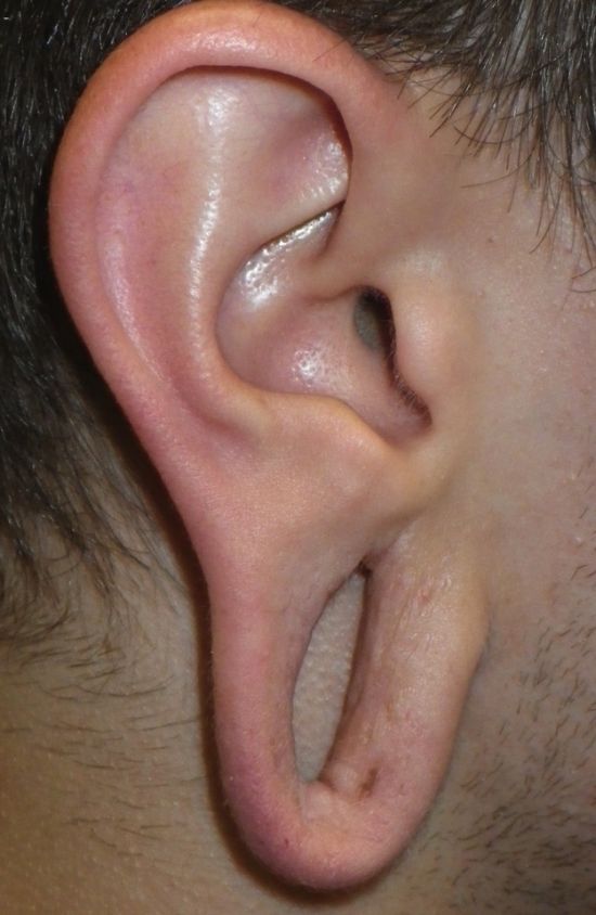 Gauged Ears Without The Gauges In