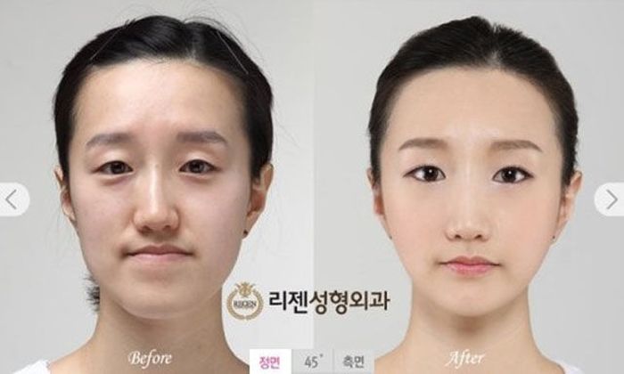 Korean Plastic Surgery, part 2