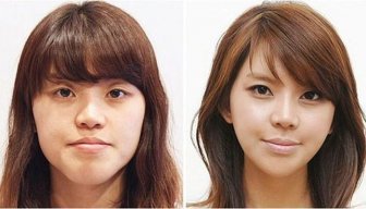 Korean Plastic Surgery