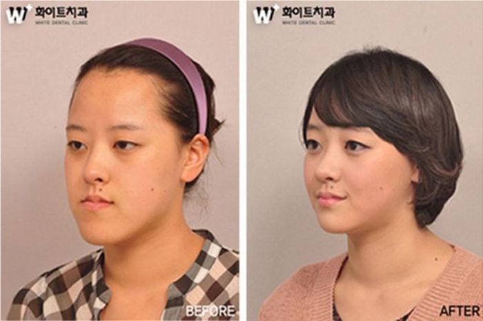 Before and After Plastic Surgery
