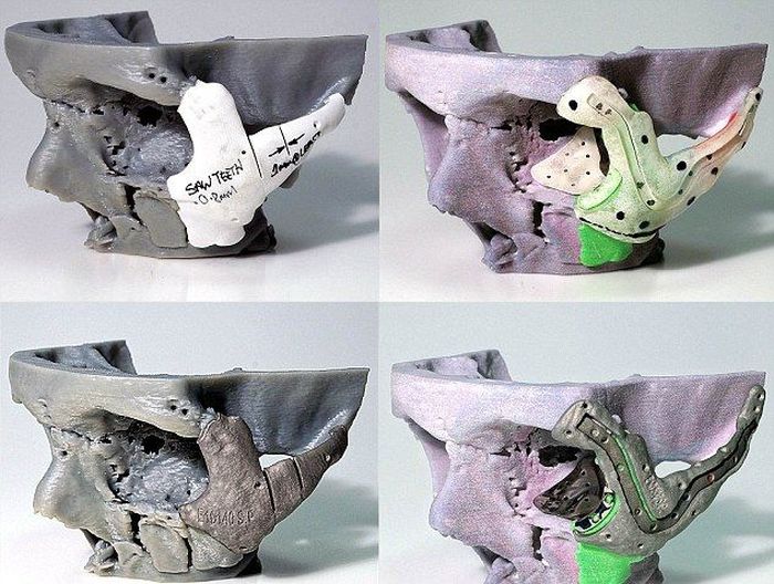 3D-Printed Skull for a Crash Victim