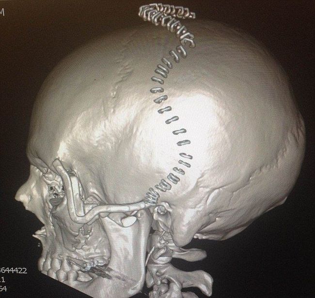 3D-Printed Skull for a Crash Victim
