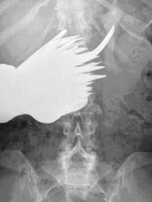 You Won't Believe What This Woman Swallowed