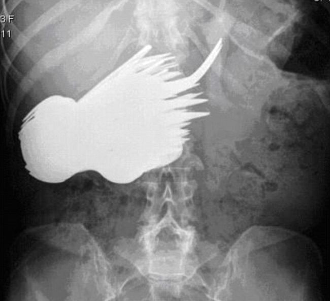 You Won't Believe What This Woman Swallowed