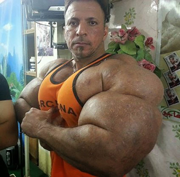 This Guy Uses Way Too Much Synthol