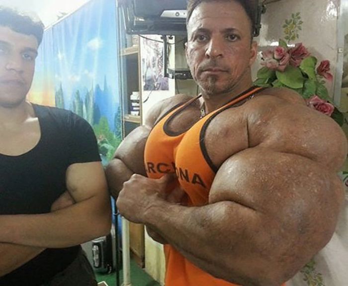 This Guy Uses Way Too Much Synthol