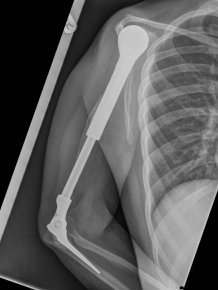 X-Ray Of A Metal Arm