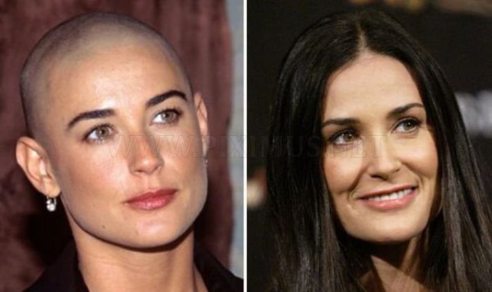 Celebrities Who Lost Their Hair 