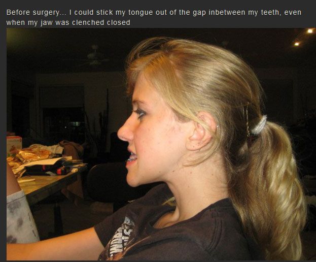 Life Changing Jaw Surgery