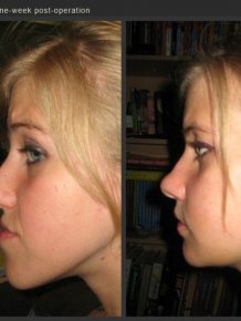 Life Changing Jaw Surgery