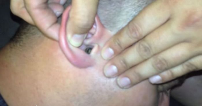 Man Has Something Terrible Stuck In His Ear