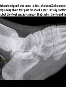 Man Thought He Had An Infected Foot But It Was Much Worse