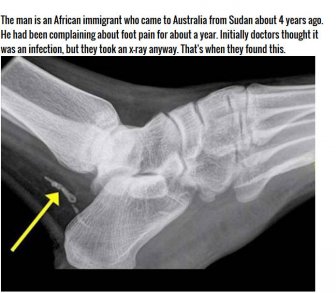 Man Thought He Had An Infected Foot But It Was Much Worse