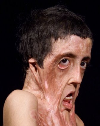 Burn Victim Gets Amazing Facial Reconstruction