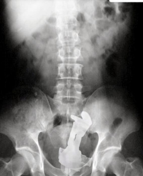 These Insane X-Rays Will Make You Wonder How That Got There