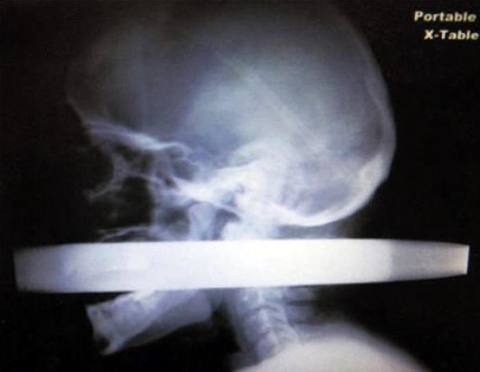 These Insane X-Rays Will Make You Wonder How That Got There