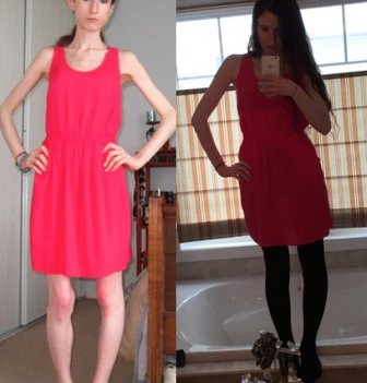 This Woman Is Looking Great After Recovering From An Eating Disorder