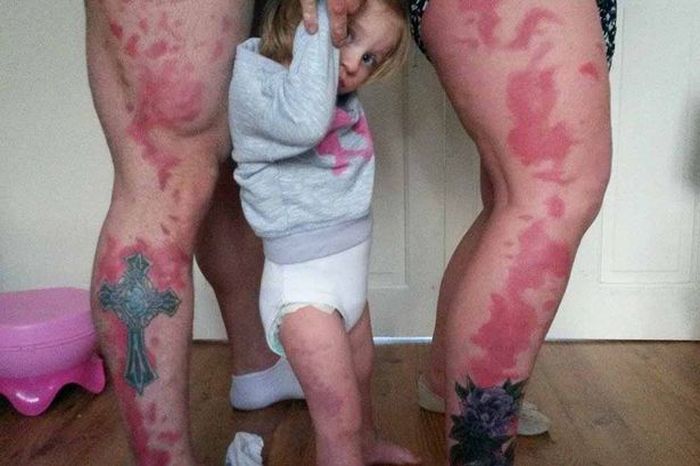 These Parents Got Their Daughter's Giant Birthmark Tattooed On Them