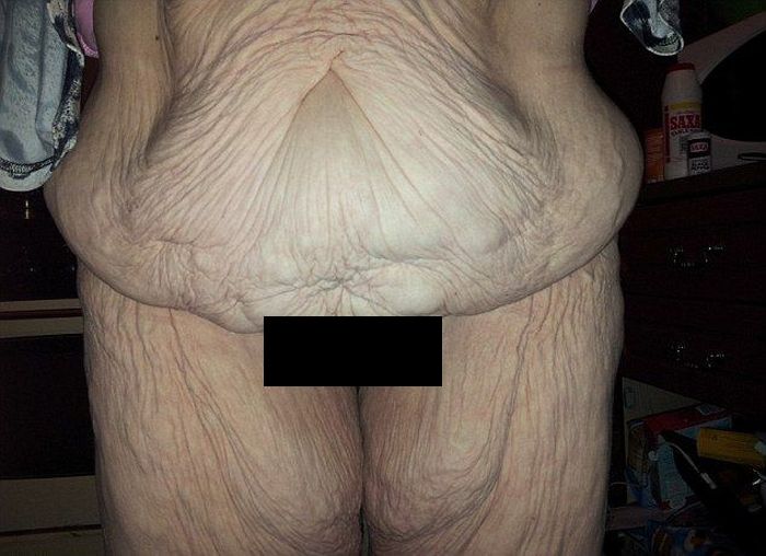 Woman Shows Off Her Body Before And After Skin Removal Surgery