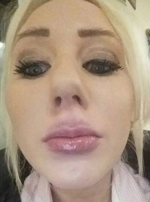 Woman Tries To Do A DIY Kylie Jenner Lip Job And It Doesn't End Well