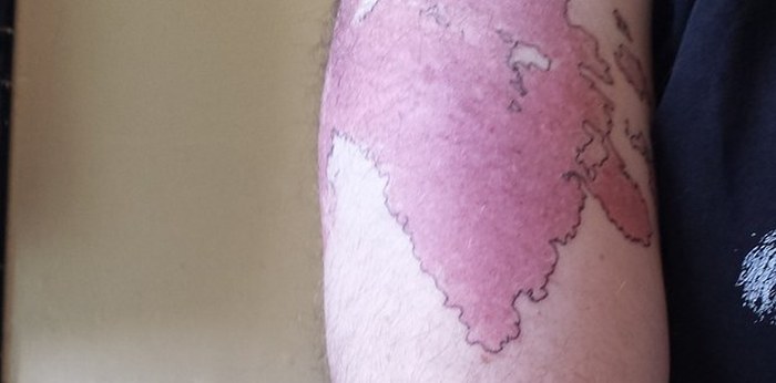 Man Transforms His Birthmark Into A Map Of A New World