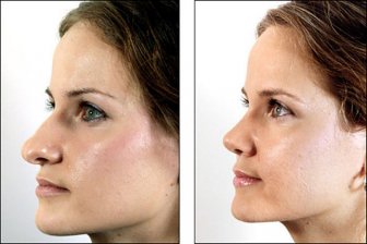 Before And After Pictures Show How A Nose Job Can Change Your Face