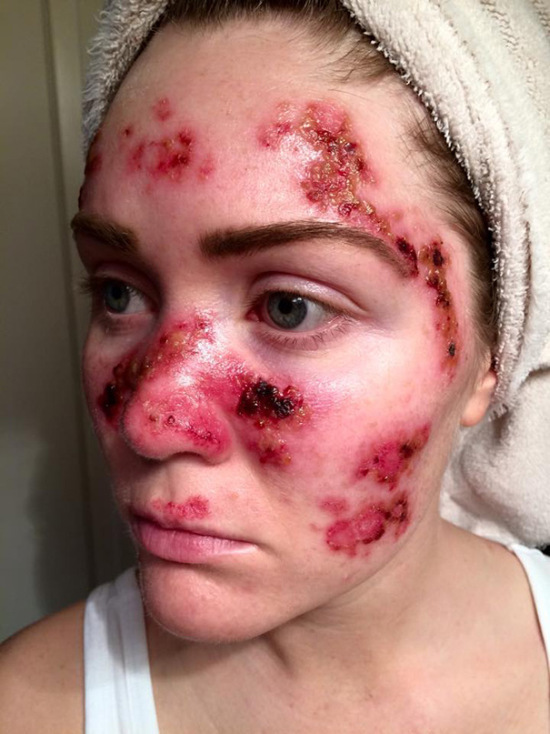 Woman Shows The Dangers Of Tanning With Graphic Selfie