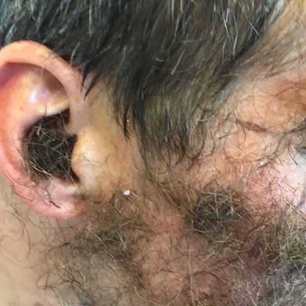 This Guy's Friends Glued Pubic Hair To His Face For His Bachelor Party