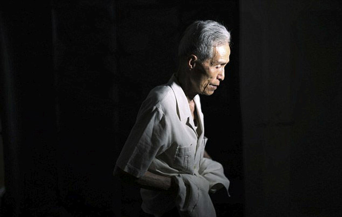 Nagasaki Bomb Survivor Shows Off The Scars Of Nuclear War