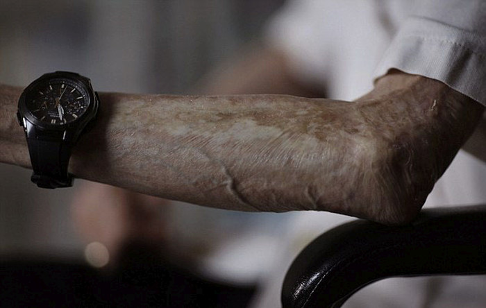 Nagasaki Bomb Survivor Shows Off The Scars Of Nuclear War