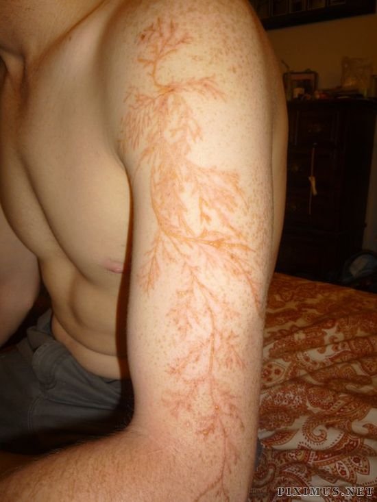 Lichtenberg Figure. Human Skin Struck by Lightning 