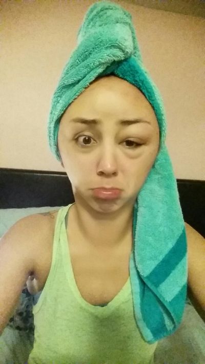Girl Ends Up With A Swollen Face After Having A Bad Reaction To Hair Dye