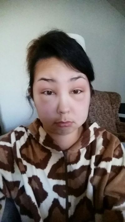 Girl Ends Up With A Swollen Face After Having A Bad Reaction To Hair Dye