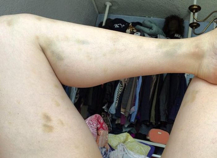 Comedian Posts Graphic Photo And Gets Serious About Abusive Relationships