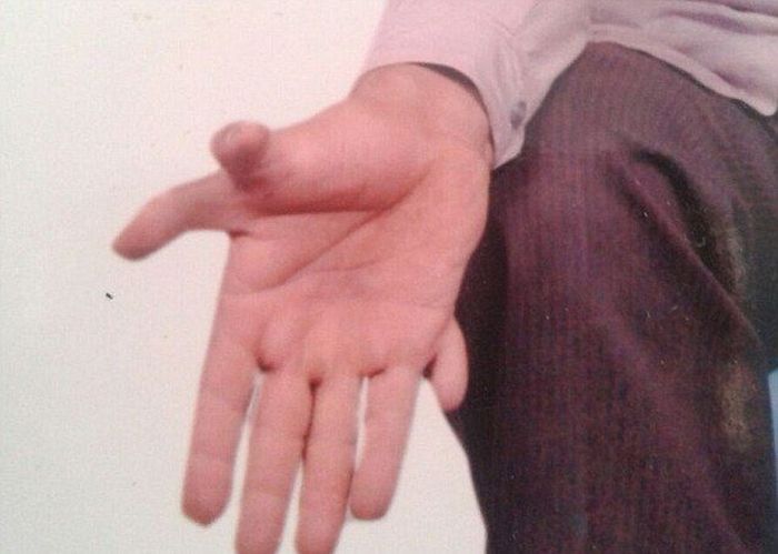 A Man In India Holds The Guinness World Record For Having The Most Fingers
