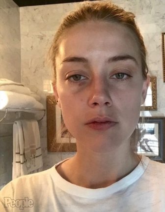 New Photos Surface From Johnny Depp's Alleged Attack On Amber Heard