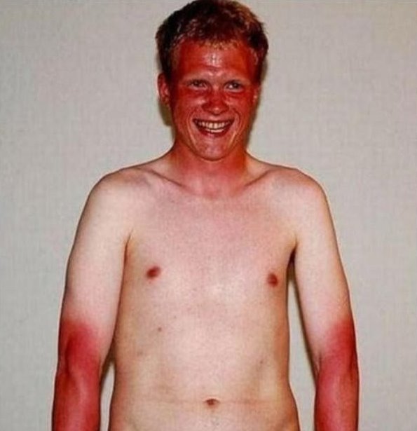 Tanning Fails Don't Get Much Worse Than This
