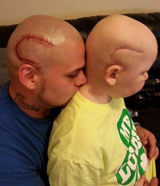 Loving Father Gets Tattoo On His Head To Match His Son's Scar