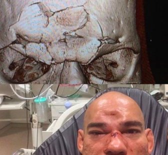 Evangelista Santos Suffers Fractured Skull Taking A Knee To The Forehead