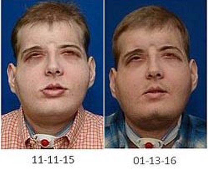 New York Firefighter Adjusts To His New Life After Receiving A Face Transplant