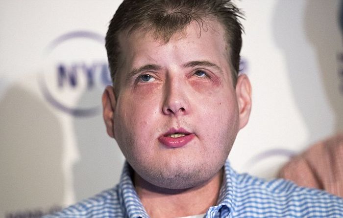 New York Firefighter Adjusts To His New Life After Receiving A Face Transplant
