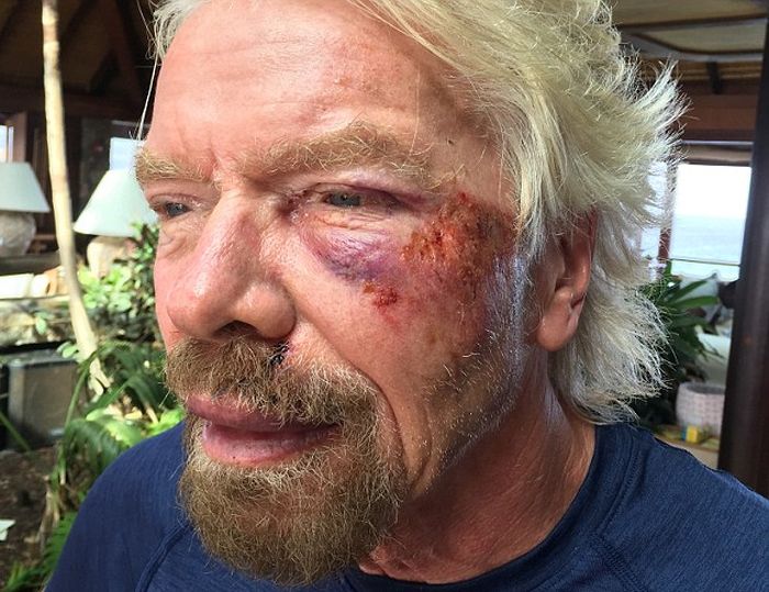 Richard Branson Receives Medical Attention After Brutal Bike Crash