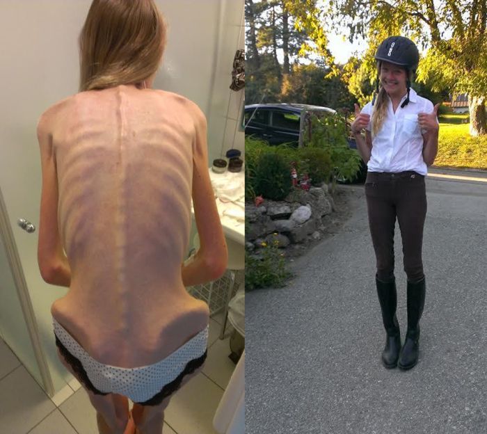 Anorexic Girl Inspires People To Get Healthy After Being Days Away From Death