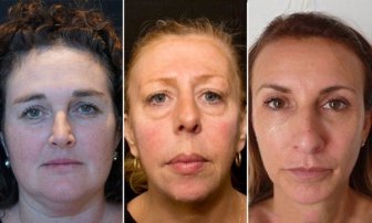 One Of These Women Has Had Filler For 10 Years