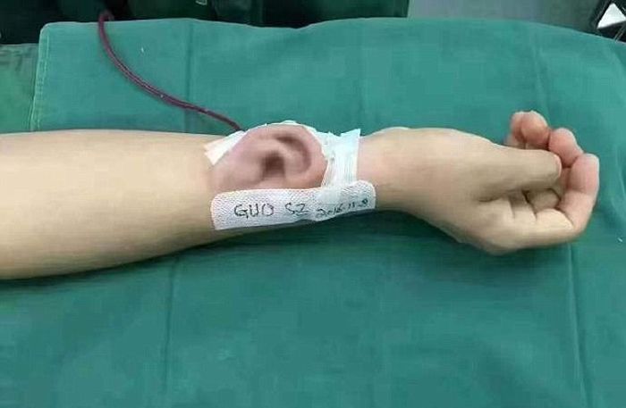 Chinese Doctor Grows Ear On Man's Arm To Help Restore His Hearing