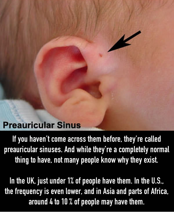 The Reason Why Some People Have Little Holes Above Their Ears