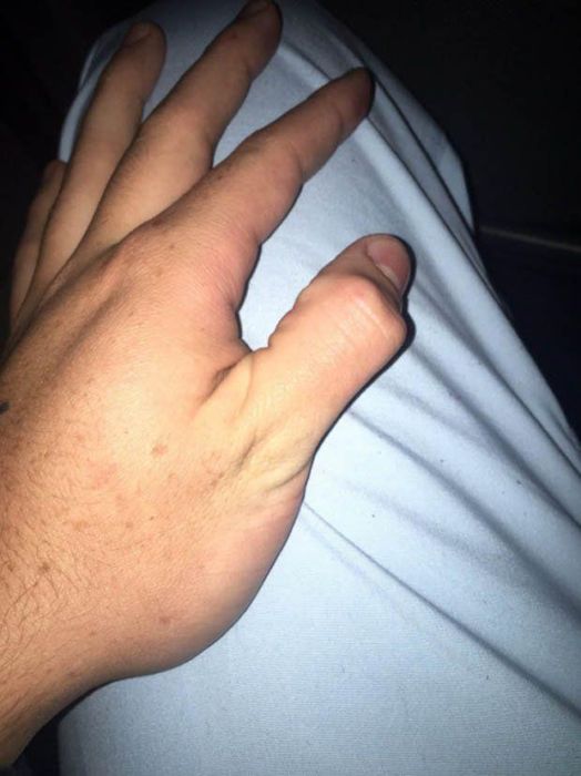 How To Dislocate Your Thumb
